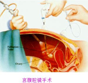 宫腹腔镜手术是怎么回事