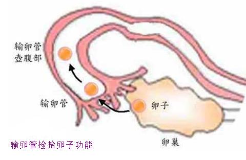 腹腔镜下输卵管造口术是治疗输卵管积水成功率