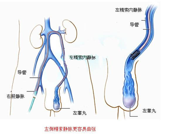 精索静脉曲张是什么病