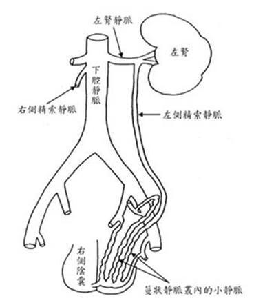 “精索静脉曲张的原因”width=302