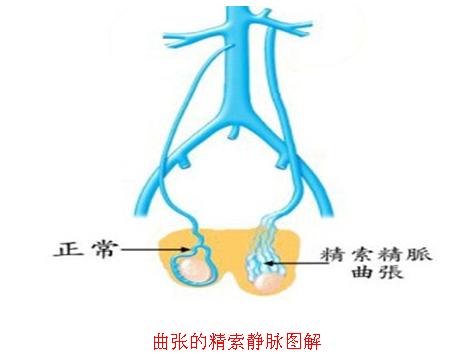 精索静脉曲张怎么治疗