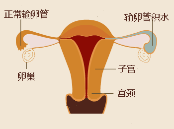 输卵管积水的症状