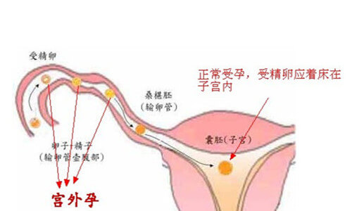 宫外孕的症状是什么?