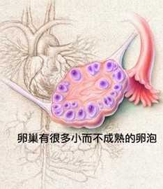 多囊卵巢综合征是不是有排卵就可以受孕